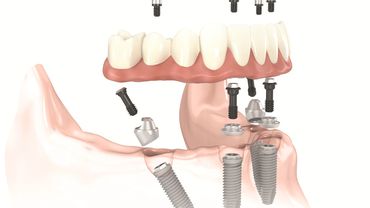 11 mitų. Visa tiesa apie dantų implantavimą