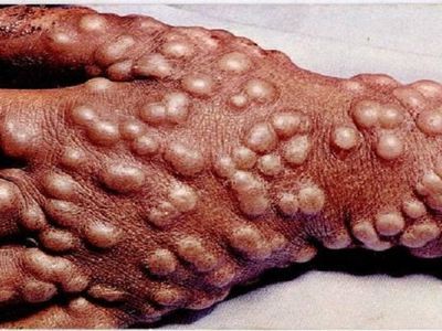 С начала года в Литве зарегистрировано уже 14 случаев заболевания оспой - Наука и здоровье