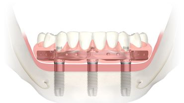 Восстановление зубов нижней челюсти на 3 имплантатах!