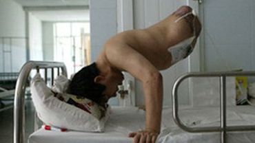 В Китае мужчина выжил после ампутации большей части тела