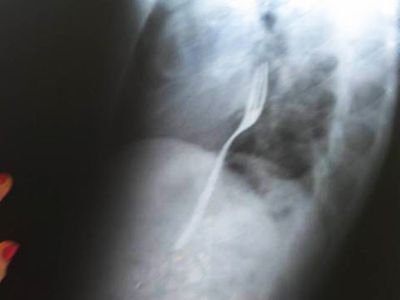 Житель Румынии проглотил вилку - Хобби, отдых и развлечения