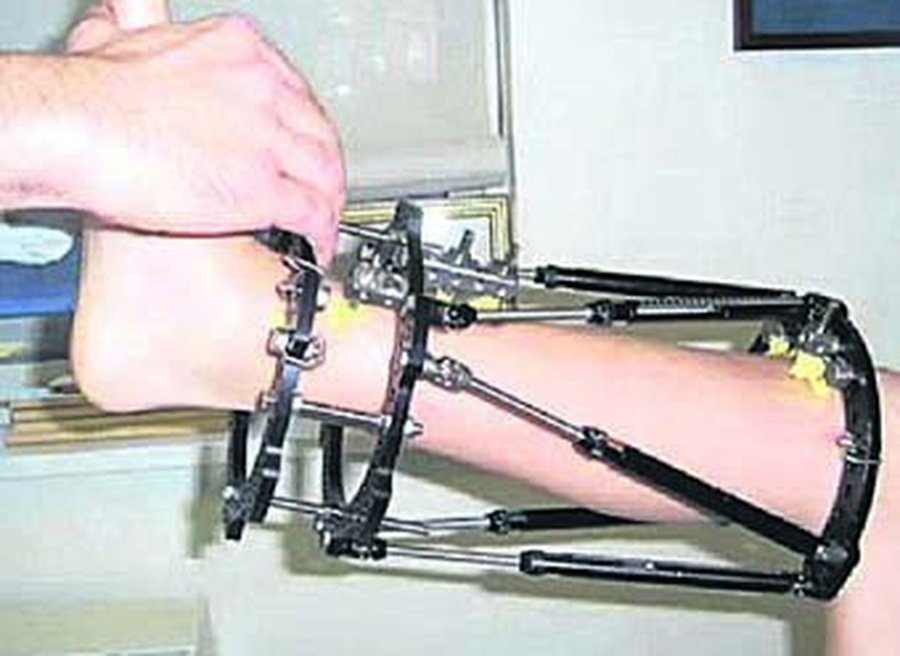 Украинский хирург удлиняет людей на 10 сантиметров за один подход - Наука и здоровье