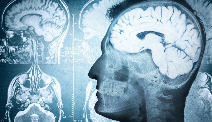 Исследователи поняли, как победить рак мозга - Наука и здоровье