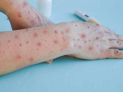 Министерство здравоохранения: в Литве подтверждены еще два случая оспы обезьян - Литва и страны Балтии