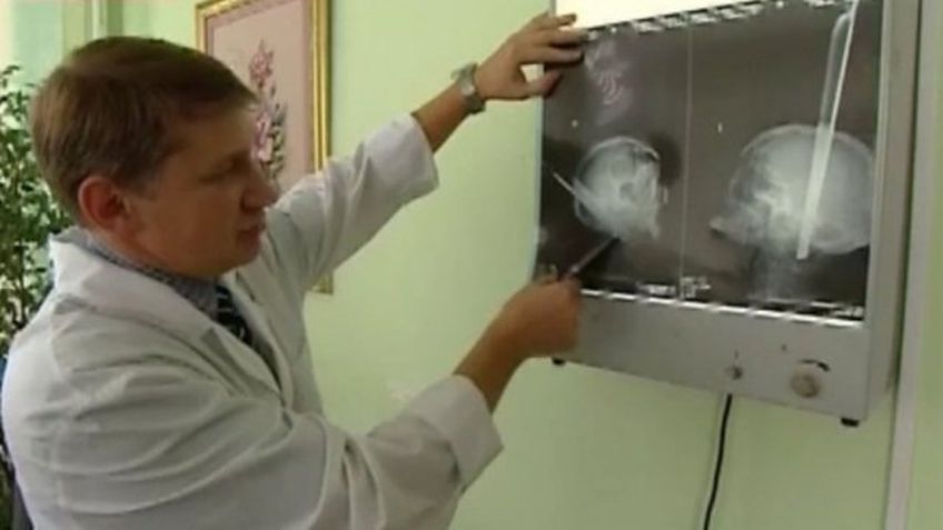 В России нейрохирурги извлекли табуретку из головы пациента