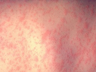 Per pastaruosius dvejus metus Europoje nuo tymų mirė 49 žmonės - Įdomu žinoti