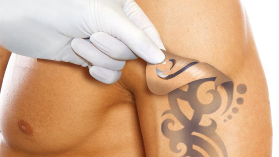 Новый лазер эффективно удалит тату