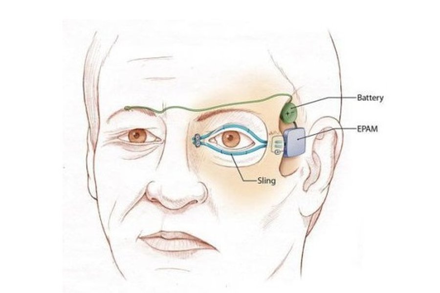 Искусственные мышцы для восстановления подвижности лица - Наука и здоровье