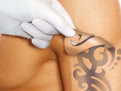 Новый лазер эффективно удалит тату - Хобби, отдых и развлечения