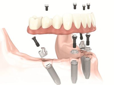 11 мифов. Вся правда об имплантации зубов - Реклама