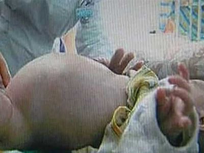 В Китае прооперировали младенца с близнецом в животе - Наука и здоровье