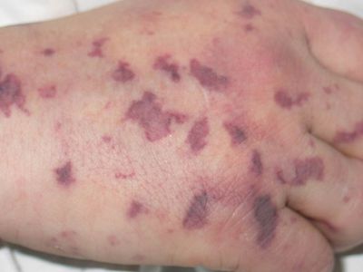 В столичном детском саду подозревают случай заболевания менингококковой инфекцией - Литва и страны Балтии