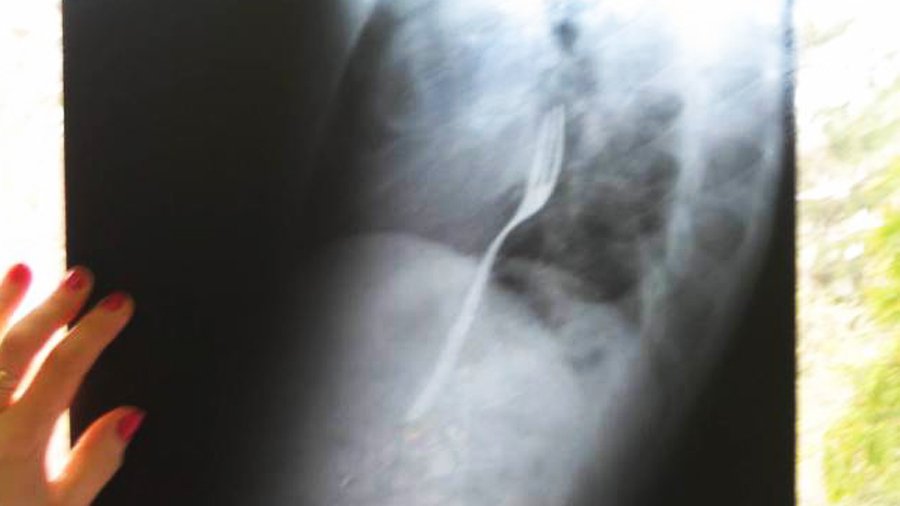 Житель Румынии проглотил вилку - Хобби, отдых и развлечения