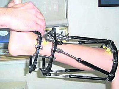 Украинский хирург удлиняет людей на 10 сантиметров за один подход - Наука и здоровье