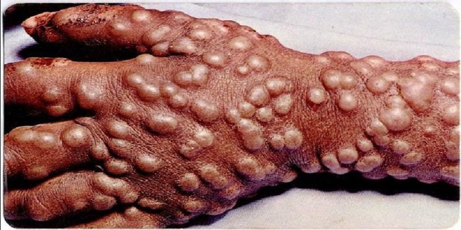 С начала года в Литве зарегистрировано уже 14 случаев заболевания оспой - Наука и здоровье