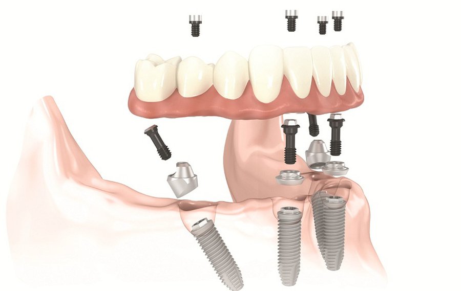 11 мифов. Вся правда об имплантации зубов - Реклама