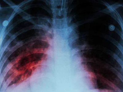 Вакцина против туберкулеза оказалась эффективнее, чем считалось - Наука и здоровье