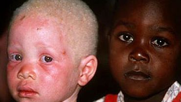 В Африке идут массовые убийства негров-альбиносов – их органы приносят удачу