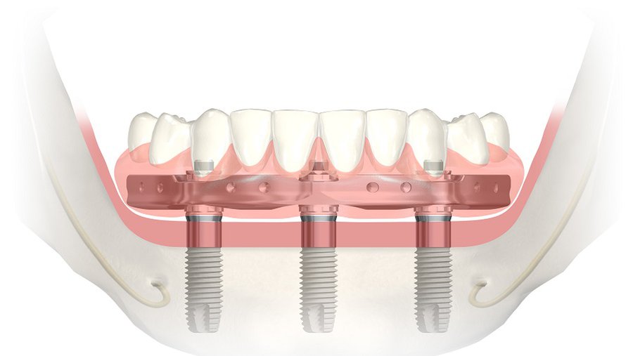 Восстановление зубов нижней челюсти на 3 имплантатах! - В Висагинасе