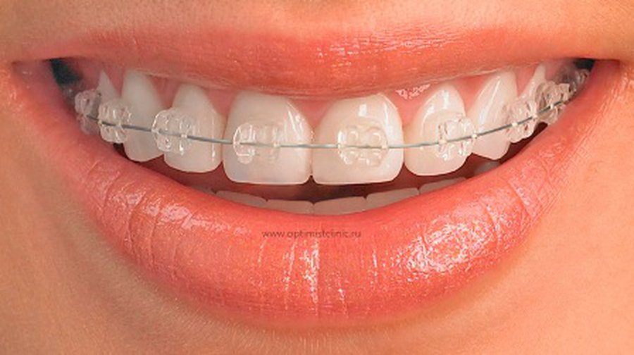 В каком возрасте еще не поздно ставить брекеты? - Наука и здоровье