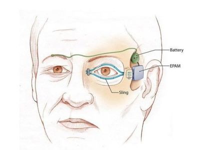 Искусственные мышцы для восстановления подвижности лица - Наука и здоровье