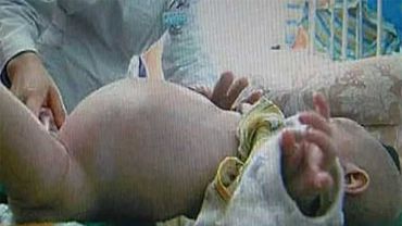 В Китае прооперировали младенца с близнецом в животе