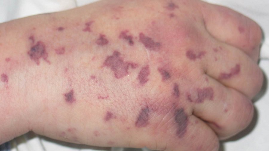 В столичном детском саду подозревают случай заболевания менингококковой инфекцией - Литва и страны Балтии