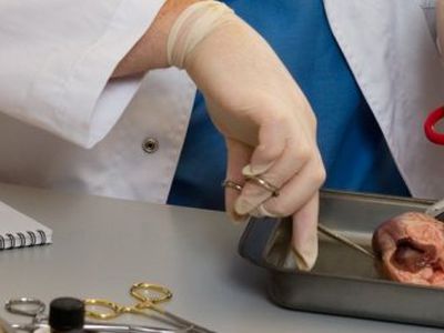 Už prekybą žmogaus organais nuteisti penki asmenys - Pasaulyje