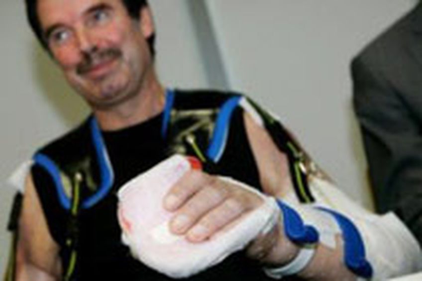 Мужчина с полностью пересаженными руками доволен результатами операции