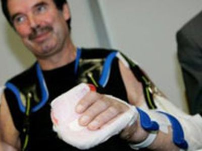 Мужчина с полностью пересаженными руками доволен результатами операции - Наука и здоровье