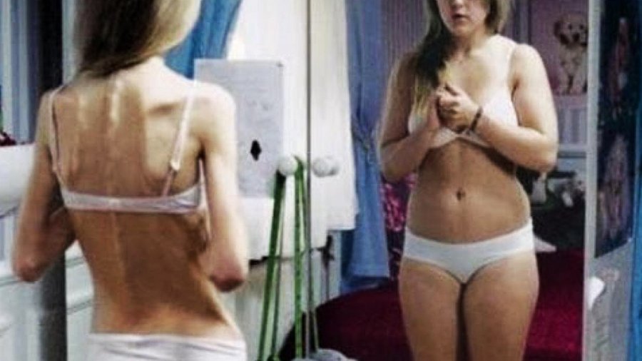 Анорексия и булимия преследуют и убивают женщин - Наука и здоровье