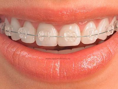 В каком возрасте еще не поздно ставить брекеты? - Наука и здоровье